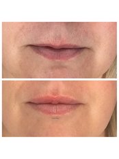 Lip Augmentation - Dr K’s Clinic