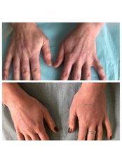 Hand Rejuvenation - Dr K’s Clinic