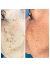 Age Spots Removal - Dr K’s Clinic