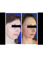 Chin Augmentation - Dr K’s Clinic