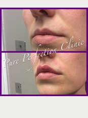 Pure Perfection Clinic - Before and After Lip Enhancement