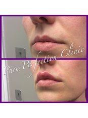 Pure Perfection Clinic - Before and After Lip Enhancement 