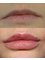 Dermaworks - Lip Filler, Before & After 
