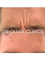 Anti Wrinkle Treatment - Dr Olivia