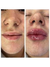 Lip Filler - 0.5ml - Allure Aesthetics by Mandy