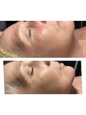Skin Peel- Lactic Hydration Peel - Zest Beauty Clinic