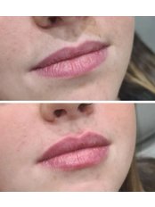 Lip Augmentation - Tanya Khan Aesthetics