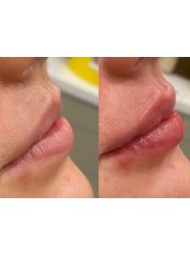 Lip Augmentation - Vermilion Cosmetic Clinic