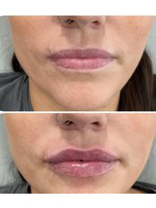Lip Augmentation - Dr Bonny Advanced Aesthetic
