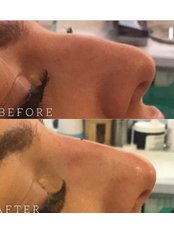 Non-Surgical Nose Job - Simply Be Beautiful