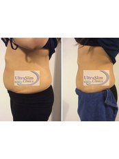 UltraSlim LipoFreeze Tummy - UltraSlim Clinics - Belfast