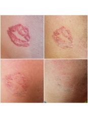 Tattoo Removal - Ink-Out Tattoo Removal