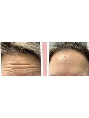 Treatment for Wrinkles (1 Area) - Skin Complete Medical Aesthetics & Skin Clinic