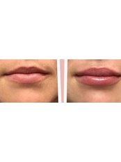 Lip Filler (0.7ml) - Skin Complete Medical Aesthetics & Skin Clinic