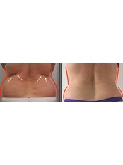 Fat Reduction Injections - Dr Cosmetic Clinic - Lisburn