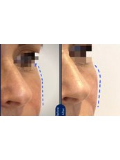 Cheek Augmentation - Dr Cosmetic Clinic - Lisburn