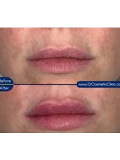 Lip Augmentation - Dr Cosmetic Clinic - Lisburn