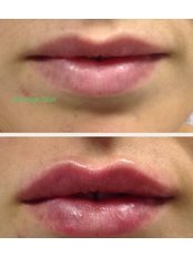 Lip Augmentation - Prestige Skin Clinic