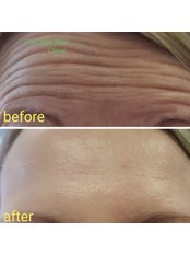 Treatment for Wrinkles - Prestige Skin Clinic