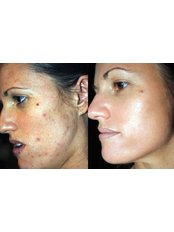 Skin Peel - Prestige Skin Clinic