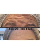 Anti Wrinkle Injections - Pure Aesthetics Clinic