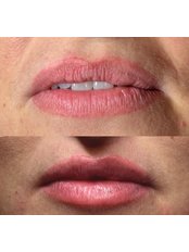 Lip Augmentation - Pure Aesthetics Clinic