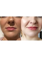 Before and immediately after lip enhancement - The Milecross Clinic