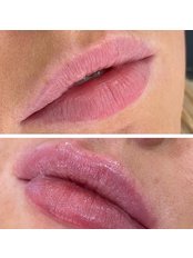 Lip Augmentation - WM Cosmetic