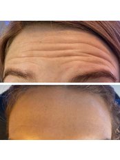 Treatment for Wrinkles - WM Cosmetic