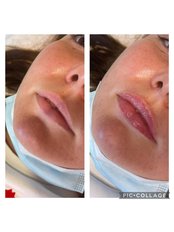 Lip filler 0.5ml  - Enhance Aesthetics