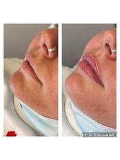 Lip filler 0.5ml  - Enhance Aesthetics