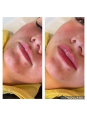 Lip filler 1ml - Enhance Aesthetics