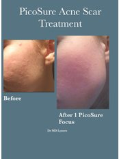Acne Scar Treatment with PicoSure Focus Lens  - UberSkin
