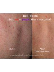 Laser and IPL Vein Treatment - Unique Skin Clinics
