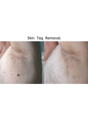 Skin Tag Removal - Unique Skin Clinics