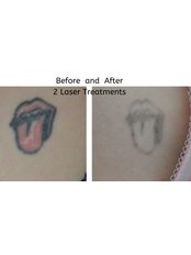 Laser Tattoo Removal - Unique Skin Clinics