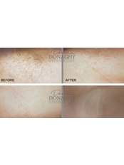 Laser Hair Removal - Donna Donaghy Skin Care