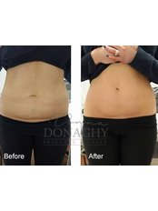 Radiofrequency Body Contouring - Donna Donaghy Skin Care