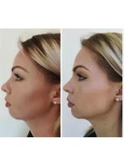 Fat Dissolving Injection - Chesterfield Aesthetics