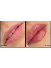 Lip Augmentation - Chesterfield Aesthetics