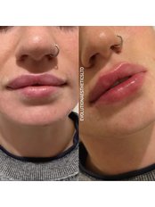 Lip Filler - Evolution Aesthetics LTD