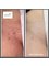 Avance Clinic - Laser Hair Removal Results After 8 Sessions 