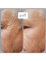 Laser Wrinkle Reduction Resurfacing - Avance Clinic