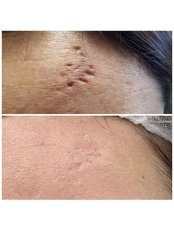 Scar Removal - Avance Clinic