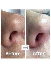 Facial Thread Vein Removal - Avance Clinic