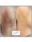 Avance Clinic - Laser Hair Removal Results After 8 Sessions 