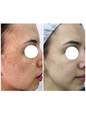 Age Spots Removal - Avance Clinic