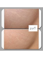 Stretch Marks Removal - Avance Clinic