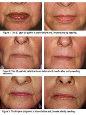 Collagen induction therapy -Dermapen - The Eden Clinic