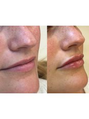 Lip Augmentation - CB Skin And Aesthetics Illkeston